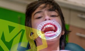 Get teeth straightened with braces.