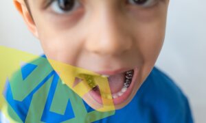 Stainless steel crowns for baby teeth.